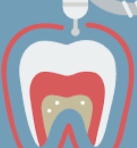 Root Canal Therapy Sydney
