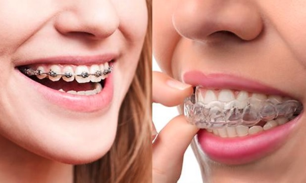 How Much Is The Average Cost Of Braces?