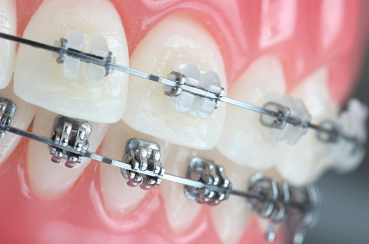 Braces Cost  Sydney CBD Dentistry