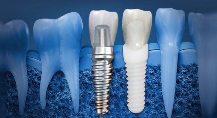 Dental Implant: Your Best Option | Sydney CBD Dentistry